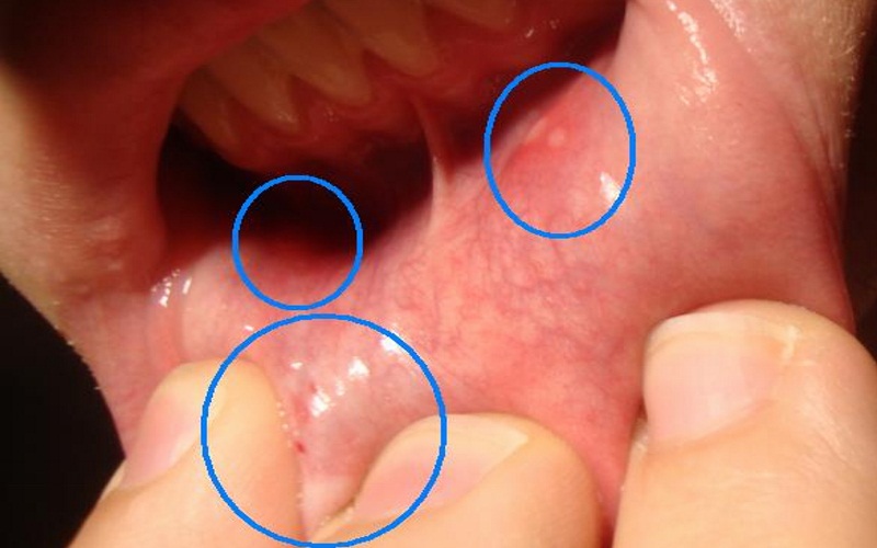 Фото – 8 Прыщ с внутренней стороны губы может быть признаком возникновения стоматита