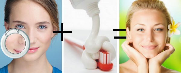 Способность зубной пасты помогать от прыщей рационально объясняется противовоспалительными свойствами средства – при этом они, эти свойства, должны определяться соответствующим компонентным составом