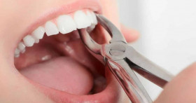 Что делать, когда тебе удалили зуб