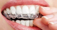 Шесть советов, как отбелить зубы самому быстро и безопасно