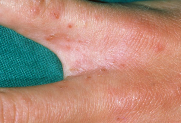 Фото – 11 Прыщи между пальцами рук, могут свидетельствовать о поражении кожи кандидозом