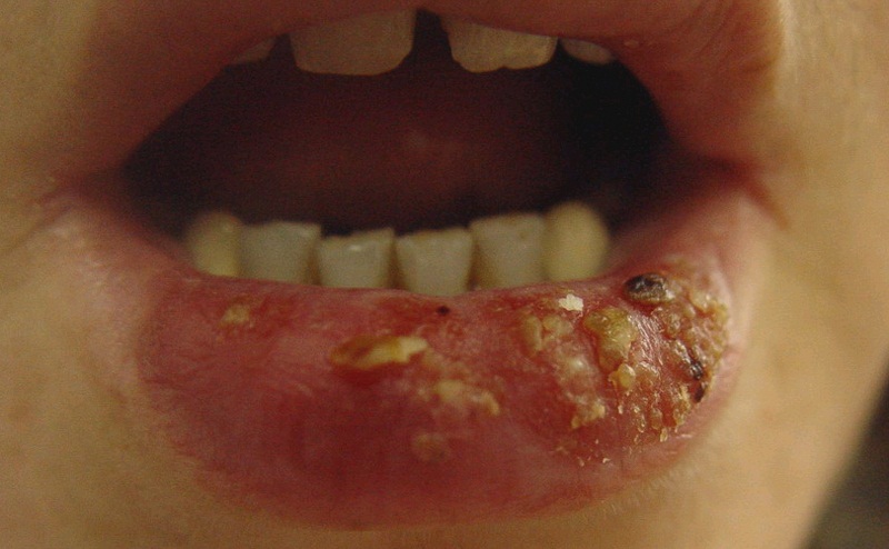 Фото – 11 Не стоит игнорировать лечение герпеса на губе, так как данный вирус может вызвать более серьезные воспалительные процессы