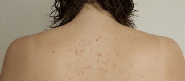Фото – 4 Прыщи на спине у женщины связаны с недостатком гигиены и состоянием здоровья