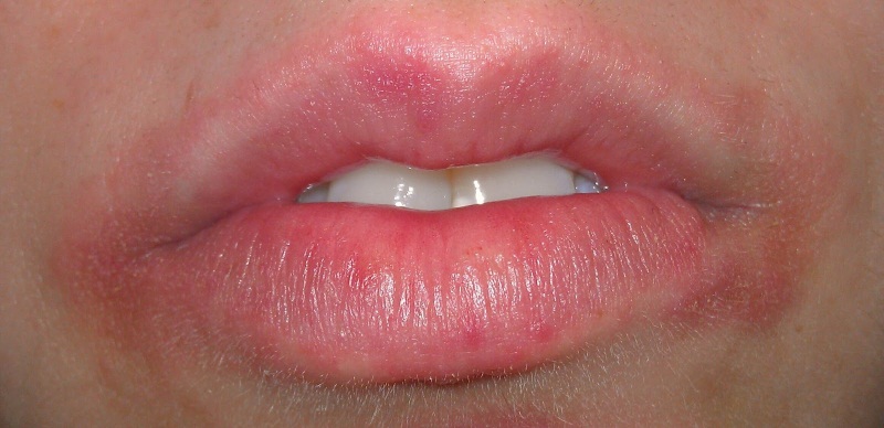 Фото – 6 Прыщи на губах могут быть следствием аллергической реакции, например на косметику
