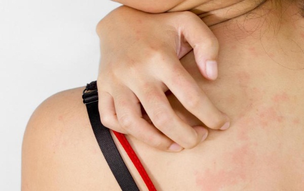Фото – 6 Сыпь на спине у женщин может быть аллергической реакцией на косметические средства