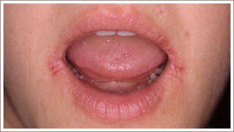 Фото – 7 Сыпь на губах, возникшая в следствии авитаминоза