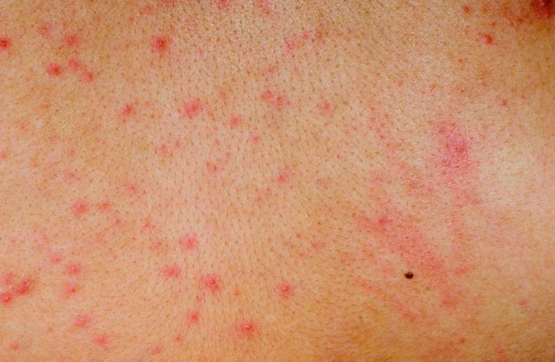 Фото – 8 Прыщи на ногах могут быть последствием аллергии