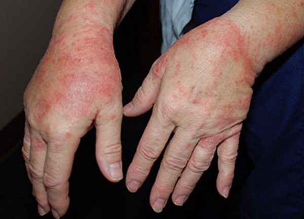 Фото – 9 Аллергическая сыпь на руках может вызывать зуд