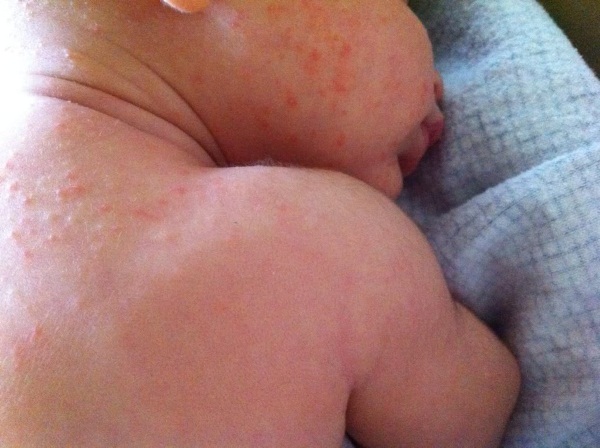 Фото – 9 Сыпь на спине ребенка может быть реакцией на пищевую аллергию