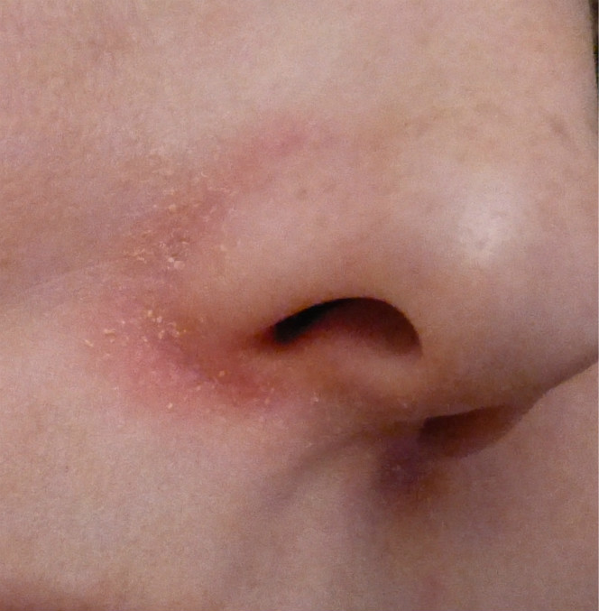 Фото — 4 Если болит прыщ возле носа, скорее всего, вы натерли кожу, и инфекция проникла очень глубоко