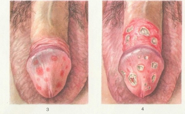 Фото — 6 Баланопостит и дерматит относятся к неинфекционным заболеваниям, и также могут поражать кожу половых органов