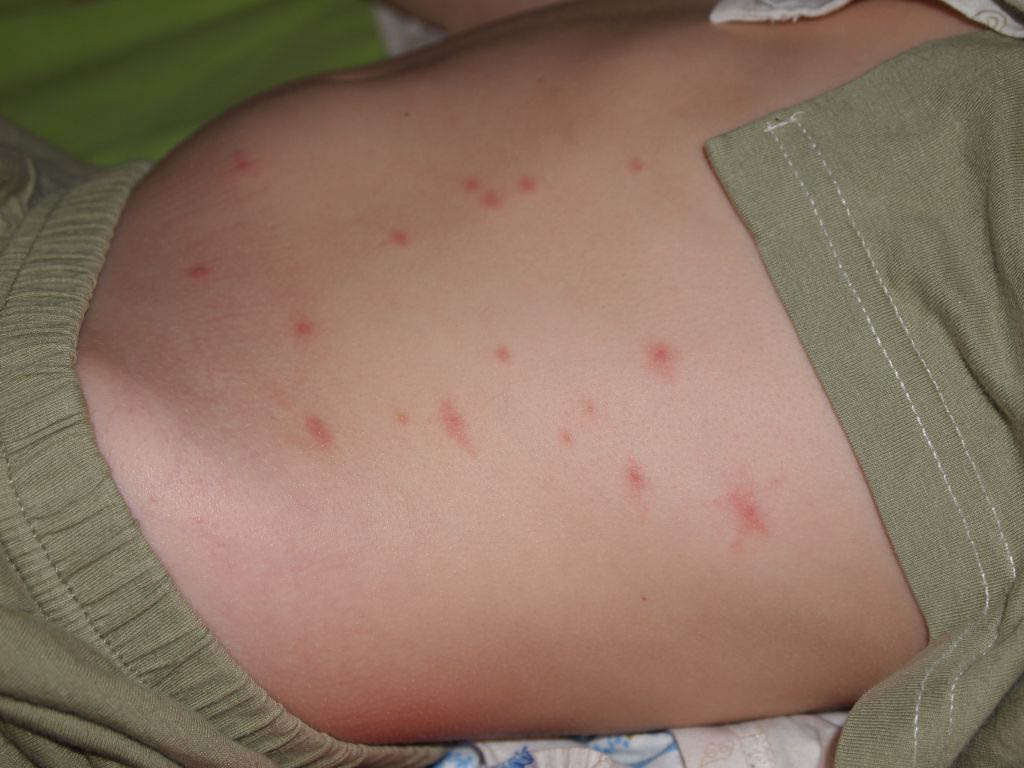 Фото — 8 Дети более подвержены различным поражениям кожных покровов