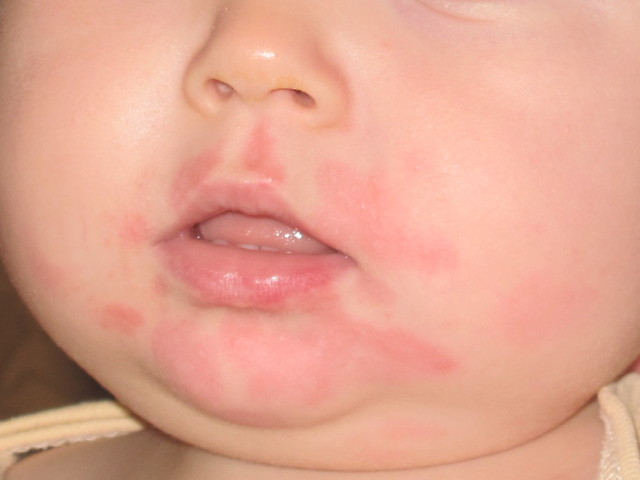 Фото — 9 Если высыпало подбородок ребенка, причиной может быть аллергия на продукты питания или на крем для лица