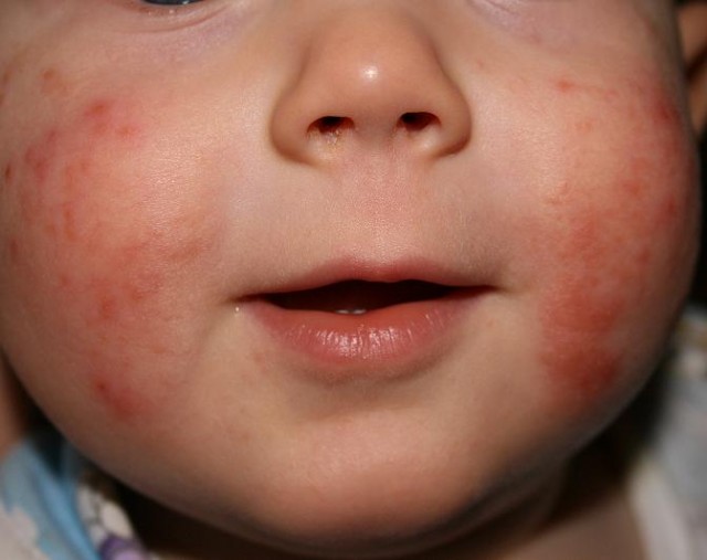 Фото — 9 Прыщи на щеках у ребенка являются очень частым явлением