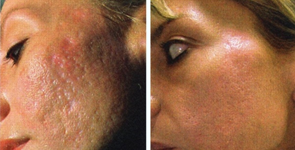 Фото – 10 В зависимости от сложности повреждений, кожу можно выровнять или с помощью косметолога, или самостоятельно 
