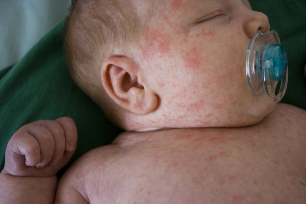 Фото – 2 У деток возрастом до 2-х лет часто причиной высыпаний является пищевая аллергия