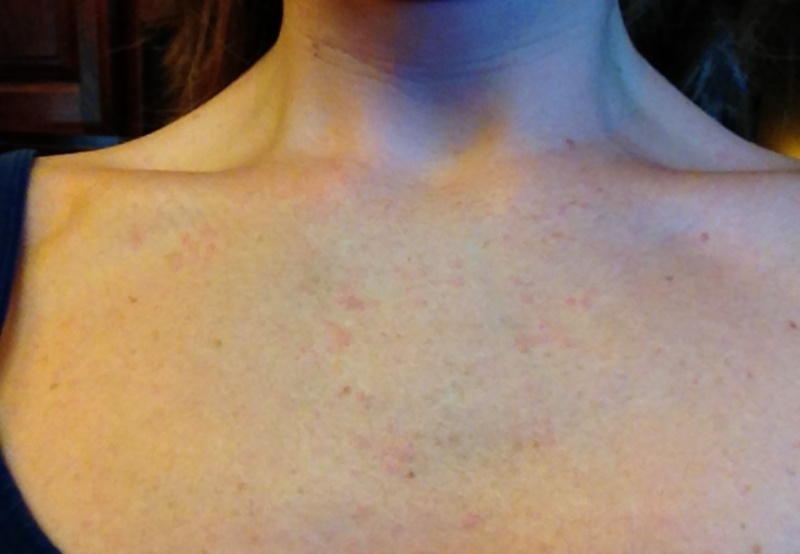 Фото – 2 Внезапная сыпь на плечах и зоне декольте может быть результатом аллергической реакции