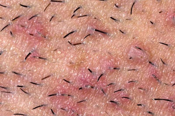 Фото – 3 Часто у мужчин воспаляются на лице волосяные фолликулы после бритья