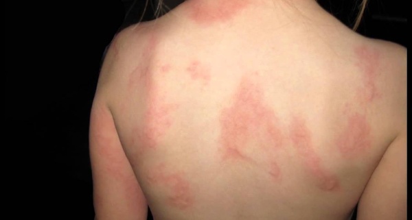 Фото – 3 Сыпь на теле у ребенка может быть проявлением крапивницы