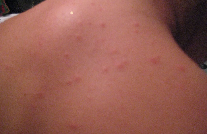 Фото – 4 Обильная сыпь на плечах может быть результатом неправильного питания, а также пониженного иммунитета 