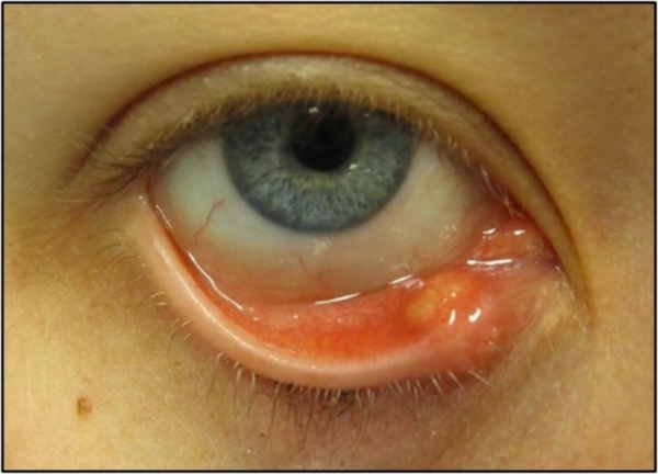 Фото – 4 Воспаление вокруг глаза очень опасно, так как инфекция может распространяться внутрь глаза