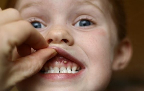 Фото – 5 Самая частая причина появления прыща во рту у ребенка – занесение инфекции