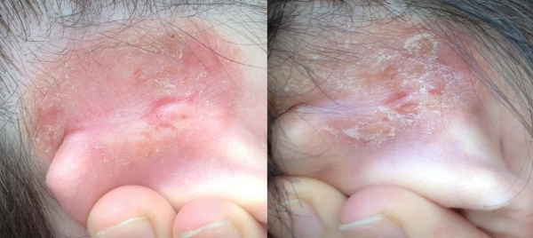 Фото – 5 Сыпь возле ушей может быть результатом аллергических реакций