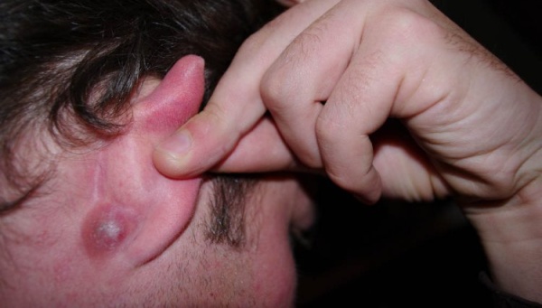 Фото – 6 Прыщи за ухом часто появляются из-за несоблюдения личной гигиены