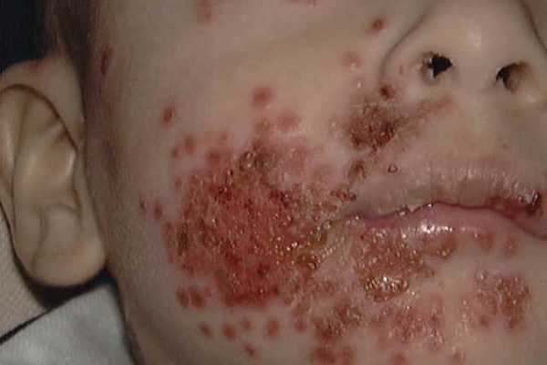 Фото – 6 Пузырчатые высыпания с жидкостью внутри могут быть результатом герпетической инфекции
