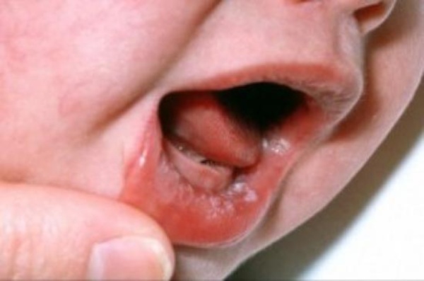 Фото – 7 Сыпь во рту у ребенка появляется при стоматите