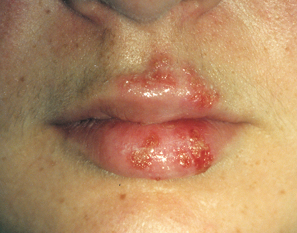 Фото 7 - Причиной прыщей на лице может быть ослабленный иммунитет