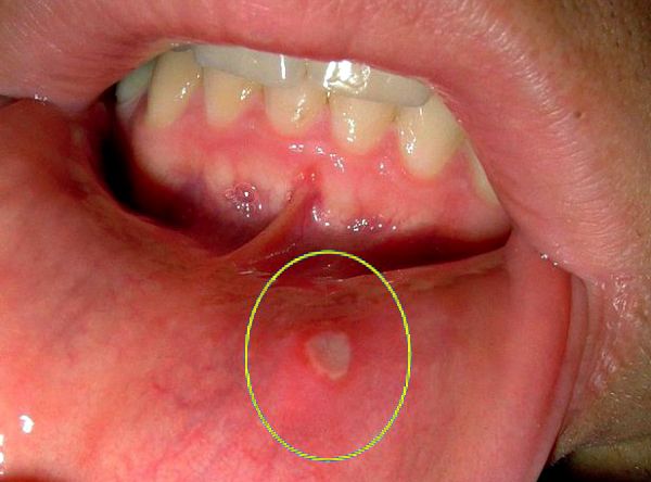 Фото 12 - Полощите рот фурацилином, если у вас стоматит