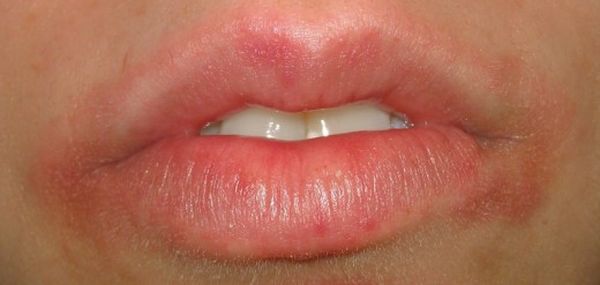 Фото 20 - Сыпь возле губ - это реакция на косметику