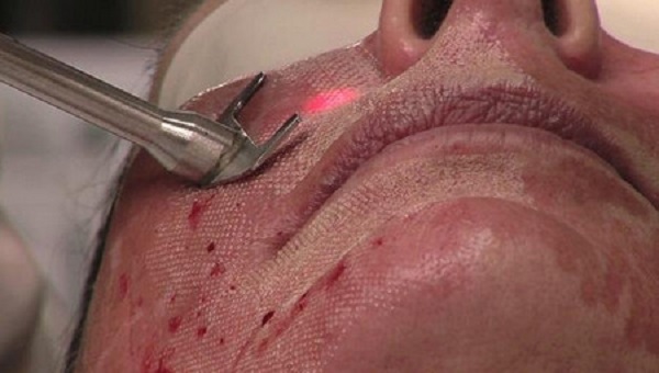 Фото 23 - Лазерное лечение сыпи на лице