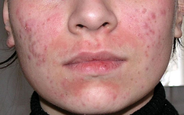 Фото 9 - Проблема аллергических прыщей на лице