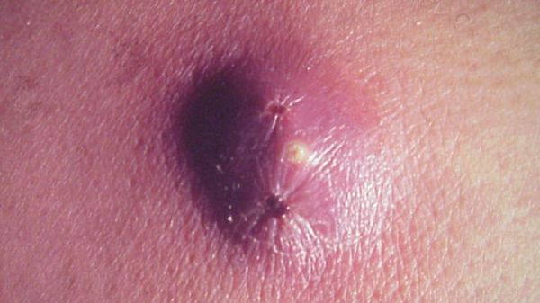 Фото 10 - Расчесанные укусы насекмы могут стать причиной фурункула