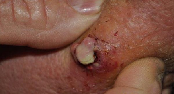 Фото 11 - Причиной фурункулов в паху может стать инфекция