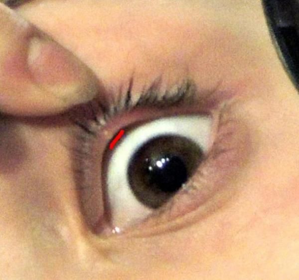 Фото 13 - Травмы глаз - причина фурункула