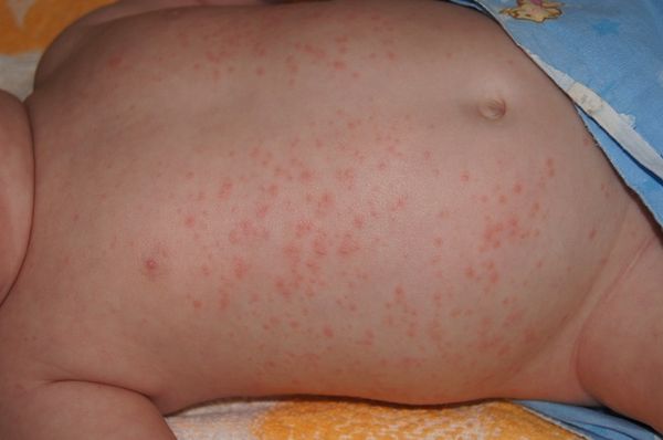 Фото 19 - Аллергия может быть по всему телу