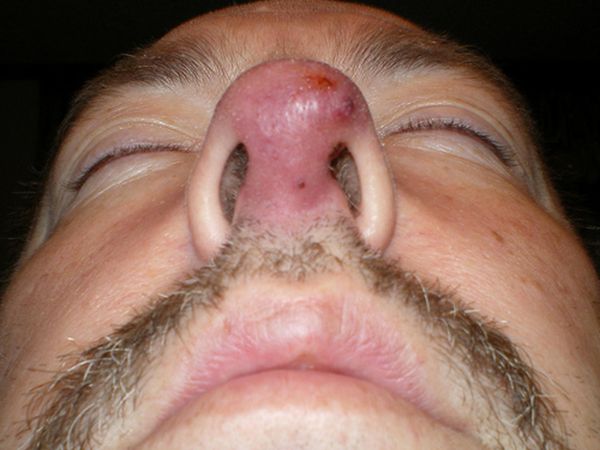 Фото 29 - Абсцедирующий фурункул носа