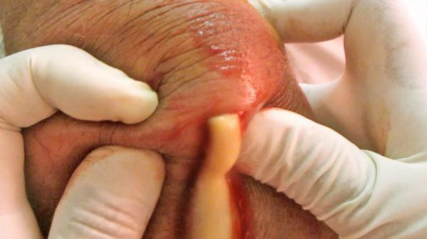 Фото 30 - Если рана после удаления гноя болит, стоит сменить способ лечения