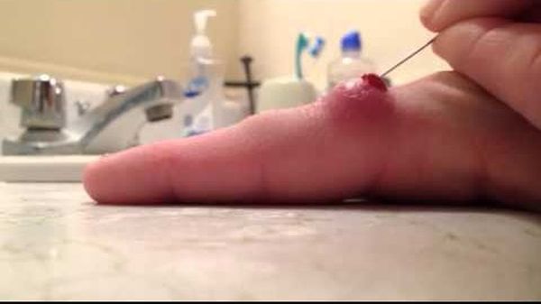Фото 31 - Лечение фурункула на пальце проводят так же как на руке или ноге