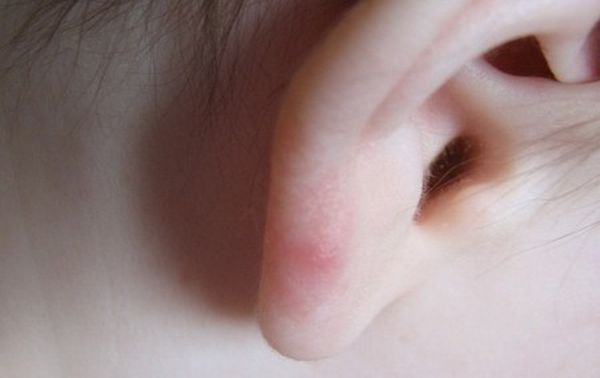 Фото 34 - Обработайте фурункул на мочке уха перекисью