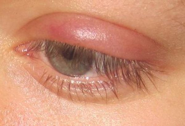 Фото 5 - Обратитесь к врачу офтальмологу при появлении фурункула на глазу