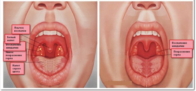 При заболевании горло и миндалины покрыты прыщами и водянистыми пузырьками