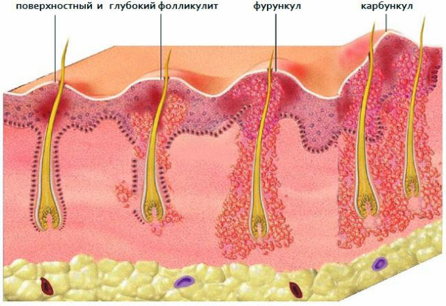 В основном причиной возникновения фурункулов на теле является не соблюдения правил гигиены и скопление бактерий под волосяным фолликулом 