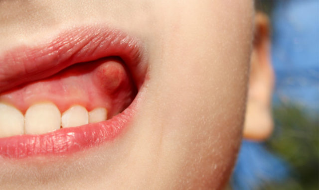 Фурункулёз полости рта представляет собой локальное гнойное воспаление тканей десны, языка, нёба или щеки