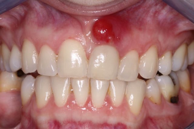 Чаще всего фурункулёз полости рта возникает в результате осложненной зубочелюстной патологии