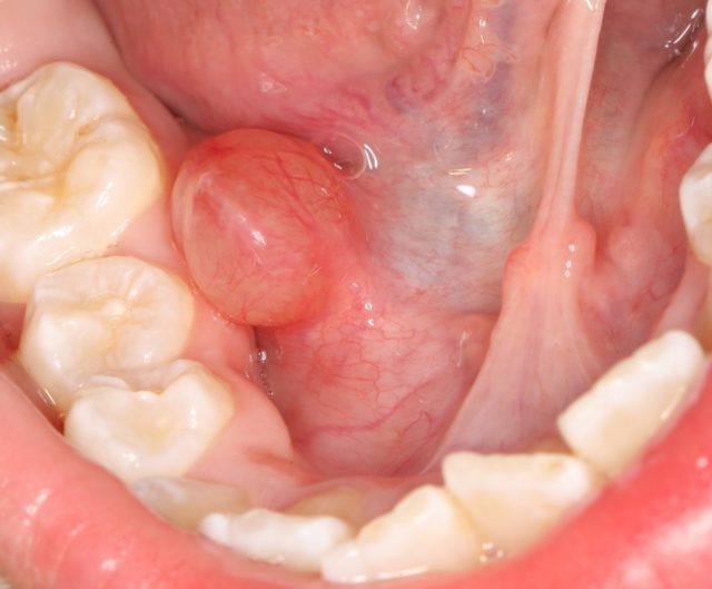 При фурункулёзе полости рта наблюдается ограниченное уплотнение и набухание слизистой оболочки