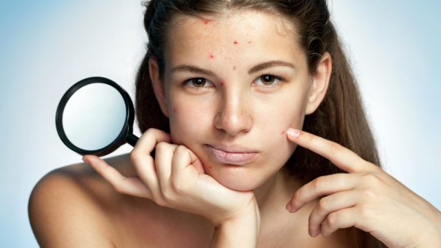 Угревая сыпь у подростков чаще всего возникает на лице, груди, и спине